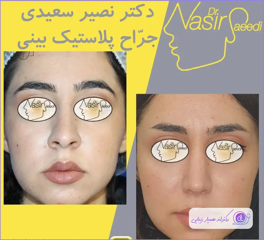 مدل قبل و بعد جراحی پلاستیک دکتر نصیر سعیدی