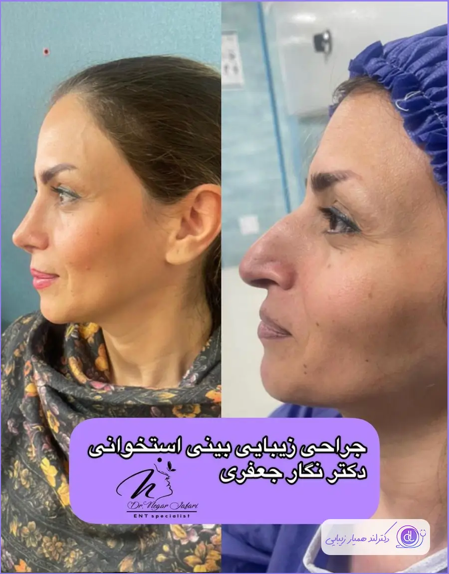 قبل و بعد عمل زیبایی دماغ استخوانی دکتر نگار جعفری در شیراز
