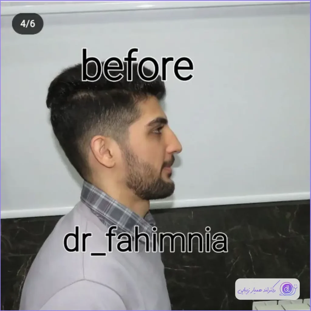 نمونه جراحی دماغ مردانه دکتر ابراهیم فهیم نیا در شیراز