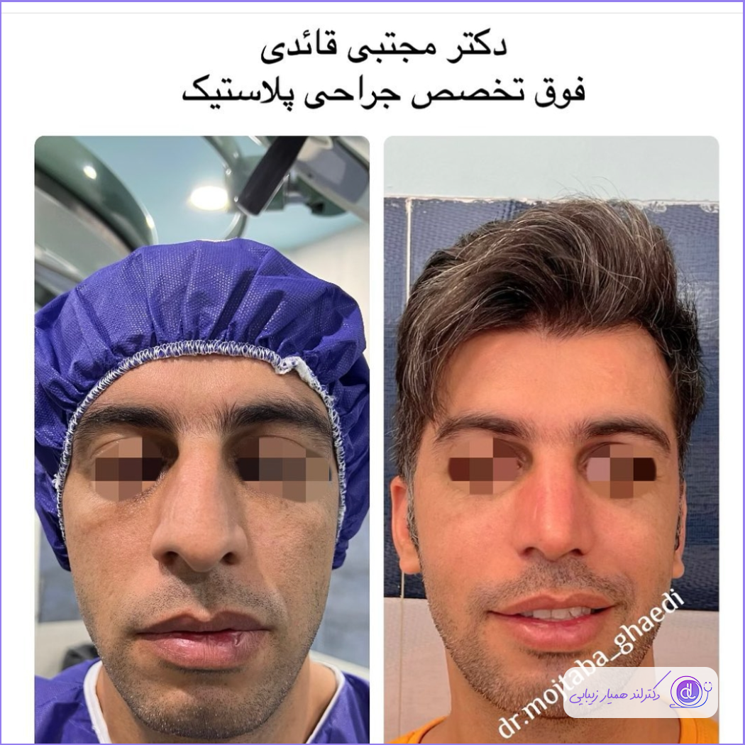 نمونه جراحی بینی مردانه دکتر مجتبی قائدی
