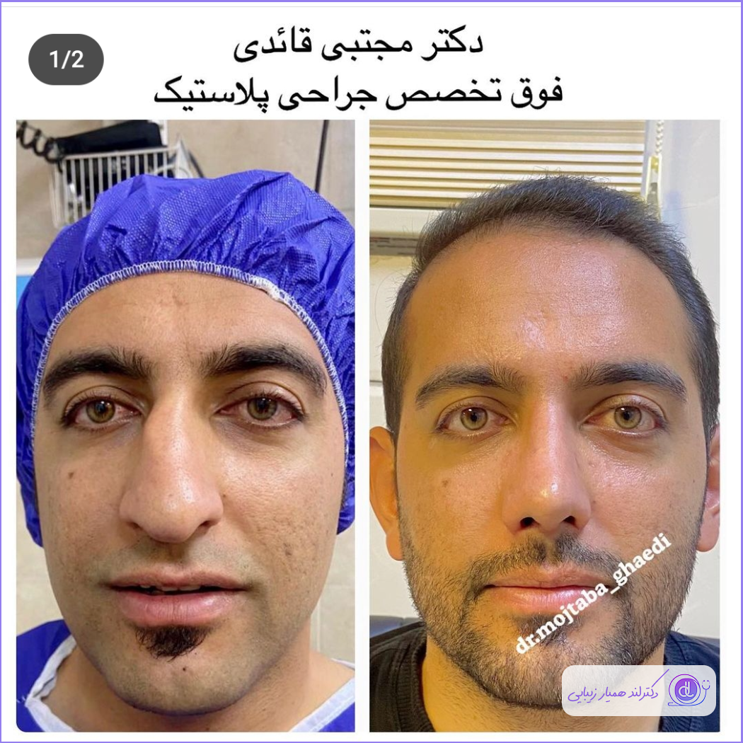 نمونه قبل و بعد عمل دماغ مردانه دکتر مجتبی قائدی
