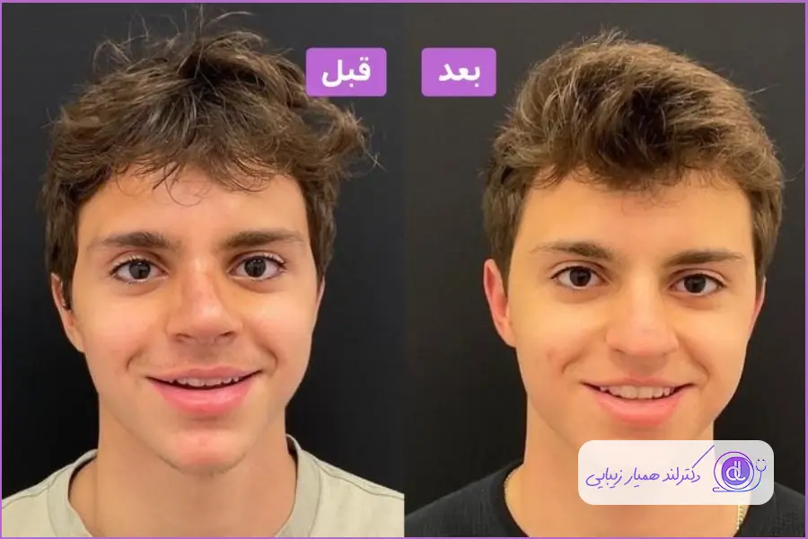 قبل و بعد عمل بینی در سن نوجوانی