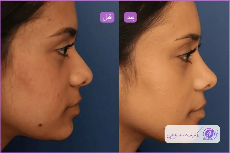 عوامل ورم صورت و پیشانی بعد از جراحی بینی