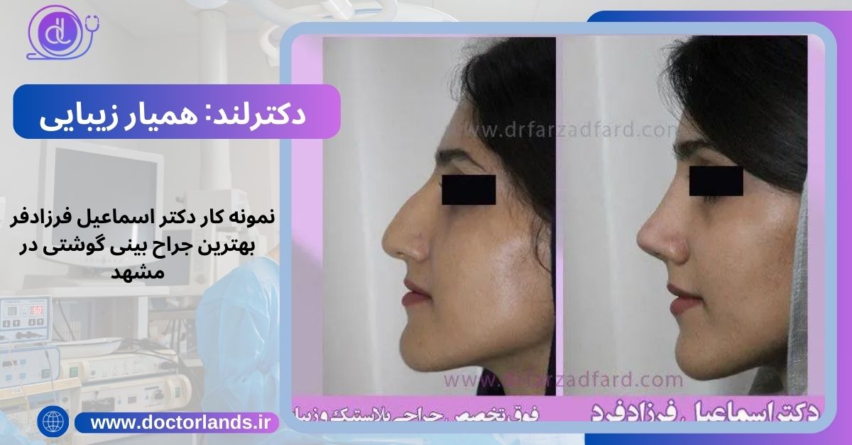 دکتر اسماعیل فرزادفر بهترین جراح بینی گوشتی در مشهد