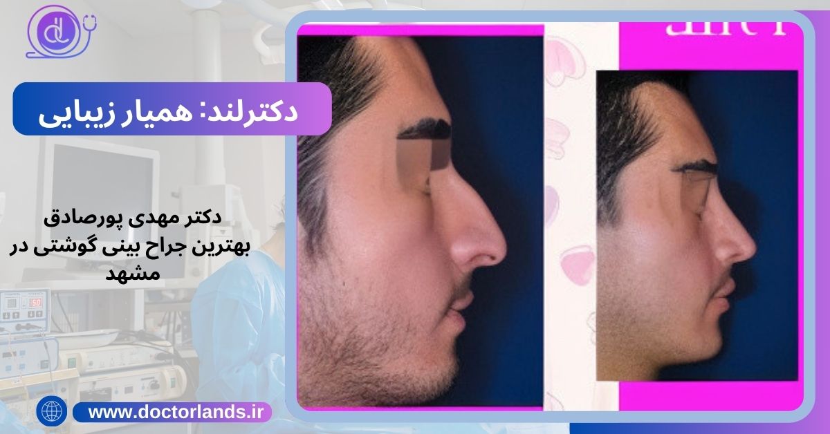 دکتر مهدی پورصادق بهترین جراح بینی گوشتی در مشهد