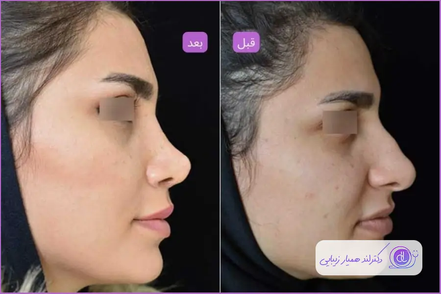 قبل و بعد جراحی بینی سبک فانتزی در کردستان