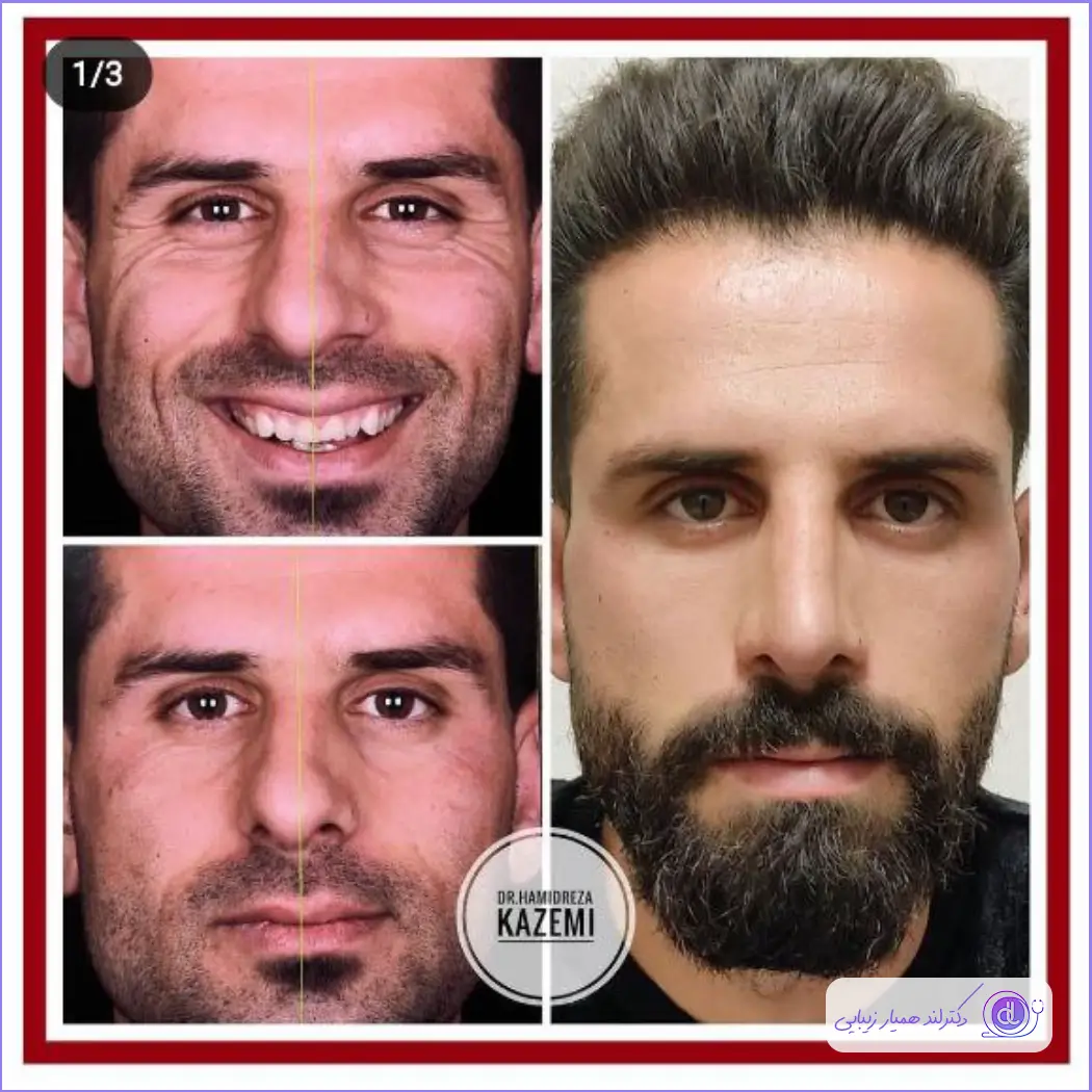 قبل و بعد عمل بینی غضروفی مردانه طبیعی 