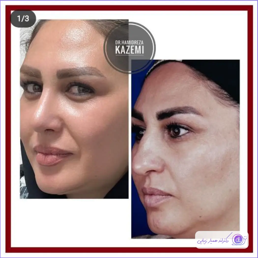 نمونه جراحی زیبایی بینی استخوانی دکتر حمیدرضا کاظمی