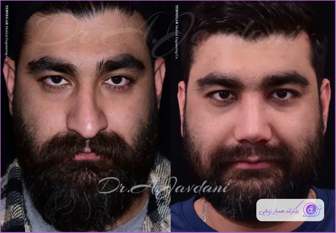 نمونه قبل و بعد جراحی دماغ گوشتی مردانه دکتر علی جاودانی