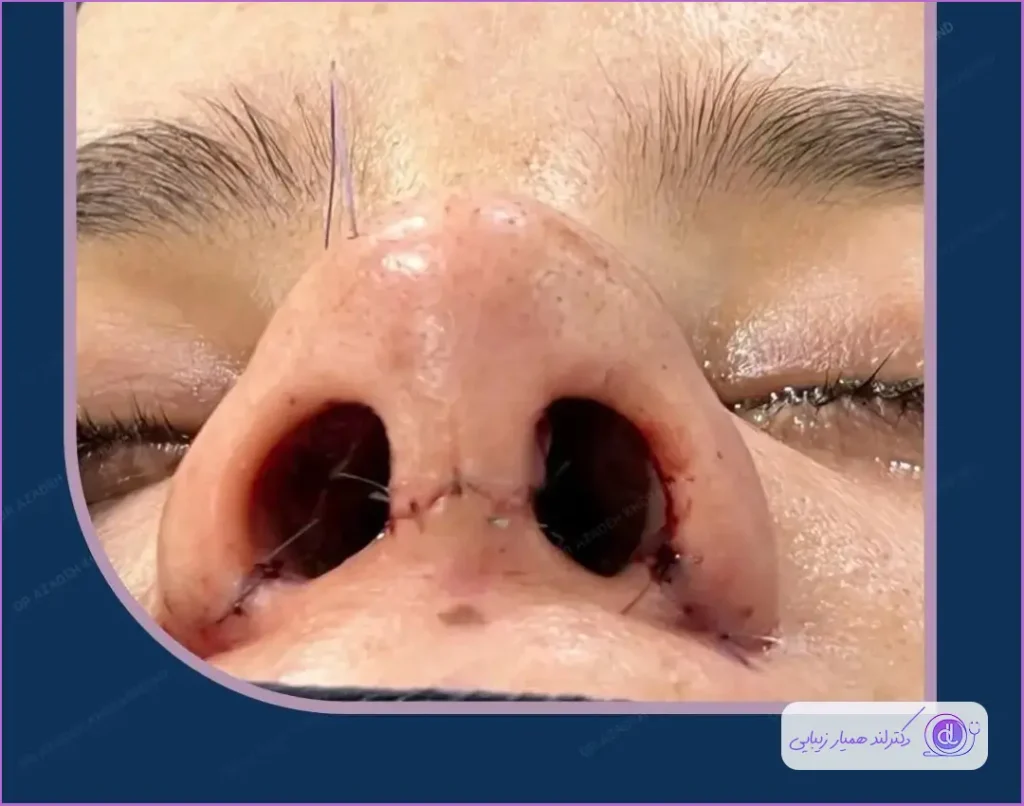 نمونه جراحی بینی به روش باز در رشت