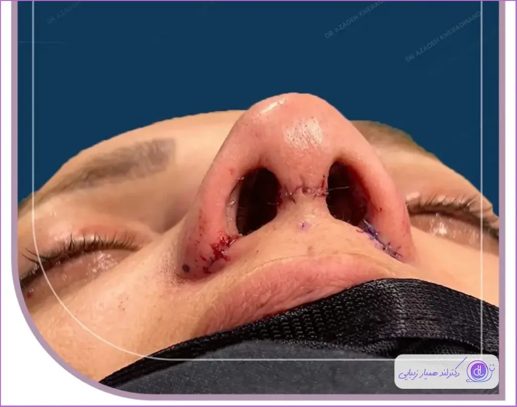 نمونه جراحی بینی به روش باز در گرگان