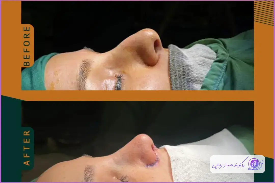 نمونه قبل و بعد جراحی بینی استخوانی دکتر بهروز گندمی
