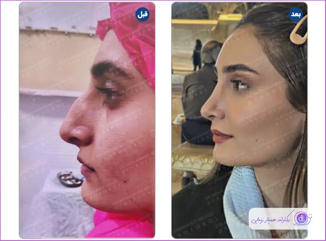 قبل و بعد جراحی دماغ استخوانی زنانه در کردستان