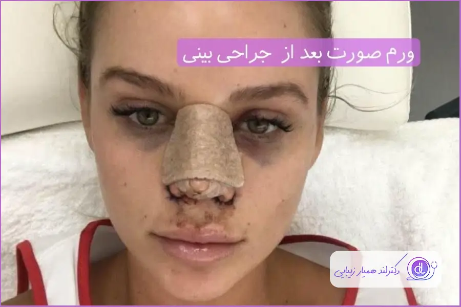 عوارض بعد از عمل جراحی بینی در مازندران