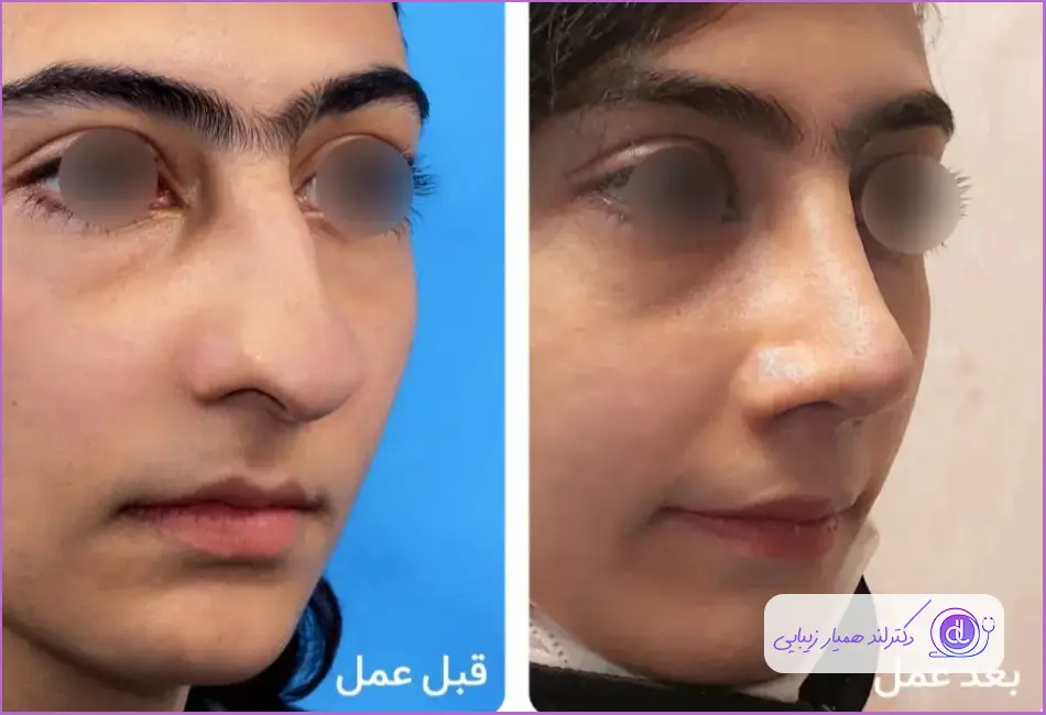 قبل و بعد جراحی زیبایی دماغ سبک نیمه فانتزی دکتر علی اصغر ذوالفقاری