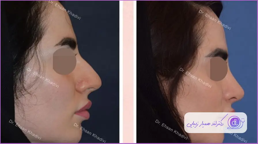 نمونه قبل و بعد جراحی بینی گوشتی زنانه دکتر احسان خدیوی
