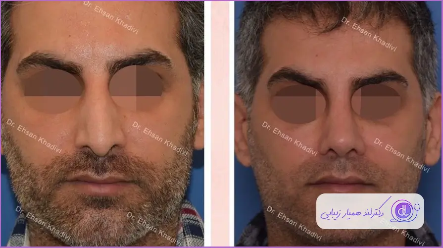 قبل و بعد عمل بینی استخوانی مردانه دکتر احسان خدیوی