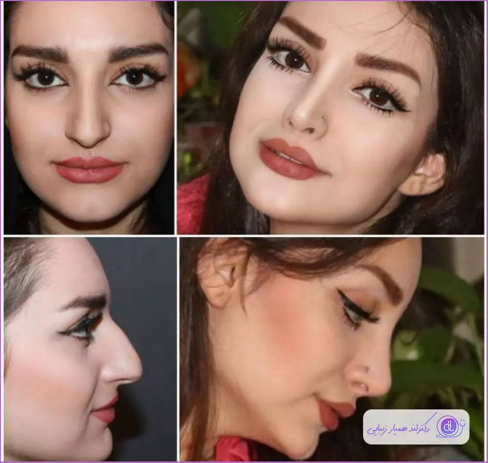 جراحی زیبایی بینی زنانه مدل نیمه فانتزی دکتر غلامرضا فیروزه ای