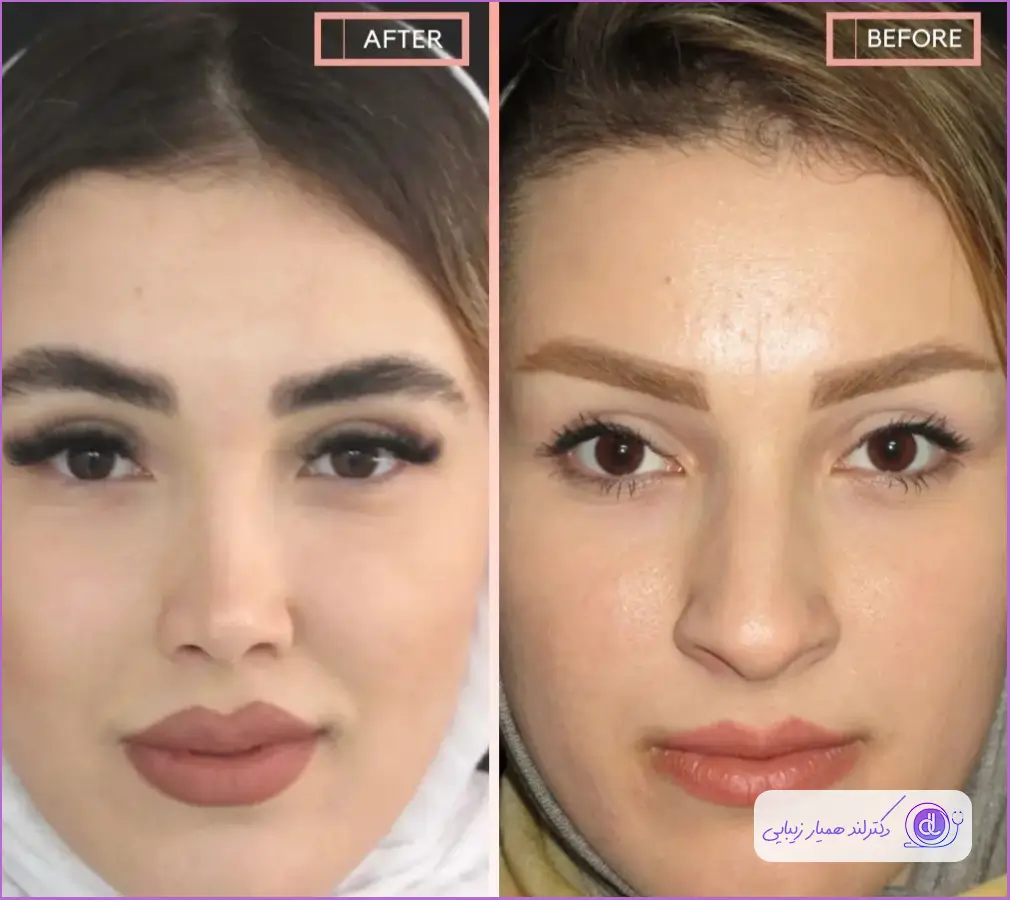 قبل و بعد جراحی دماغ گوشتی زنانه در کرمانشاه