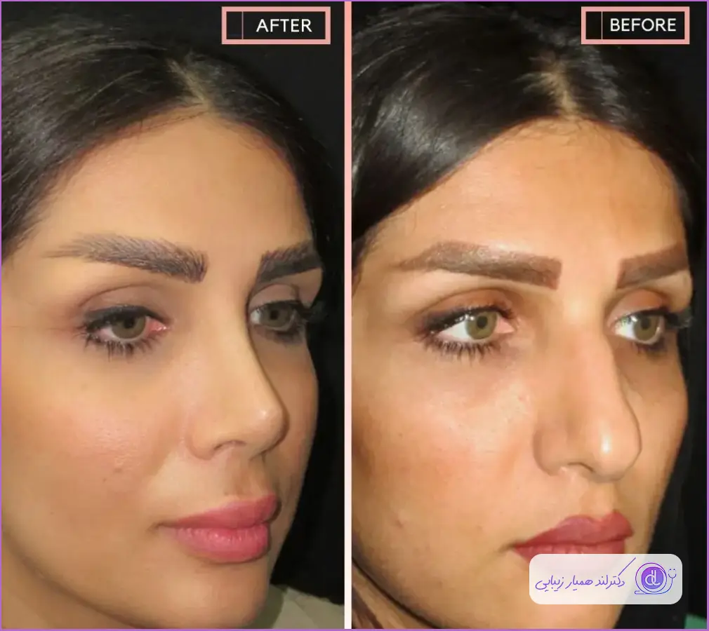 قبل و بعد جراحی زیبایی زنانه سبک نیمه فانتزی در قزوین