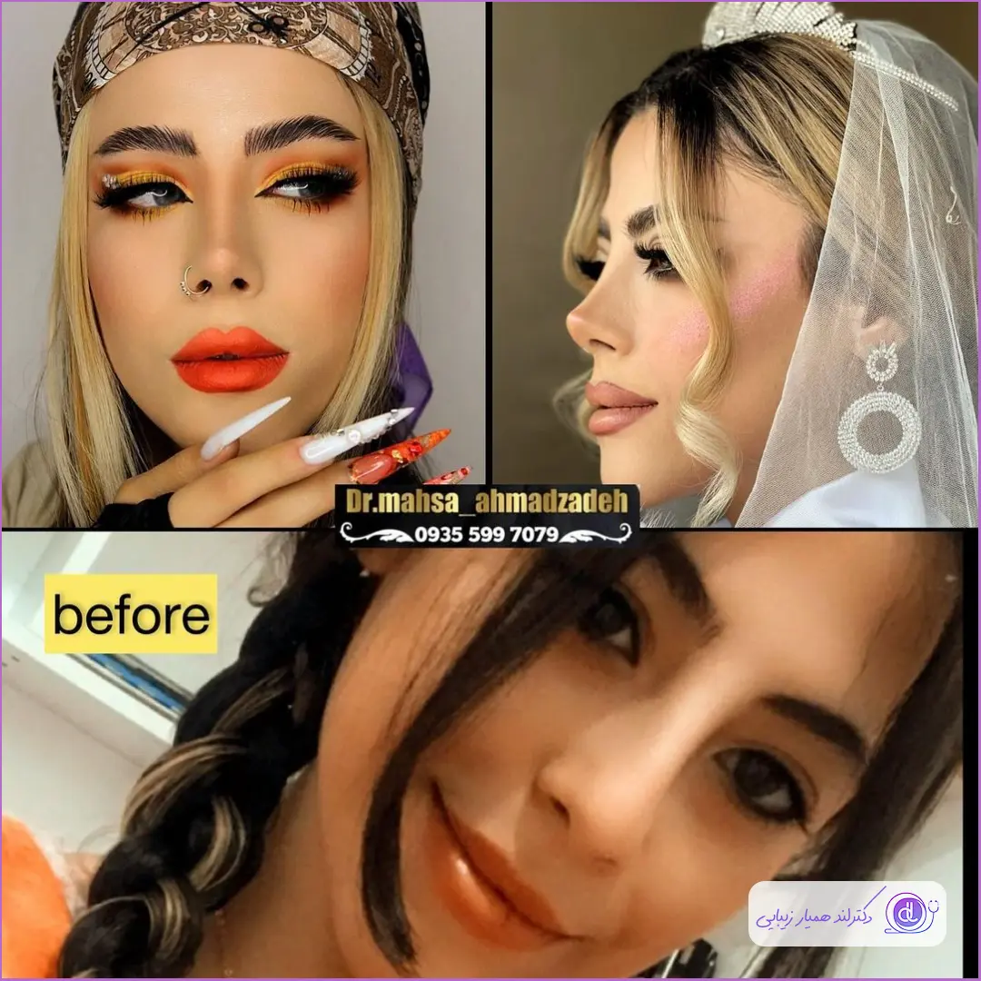 قبل و بعد جراحی زیبایی بینی گوشتی دخترانه دکتر مهسا احمدزاده