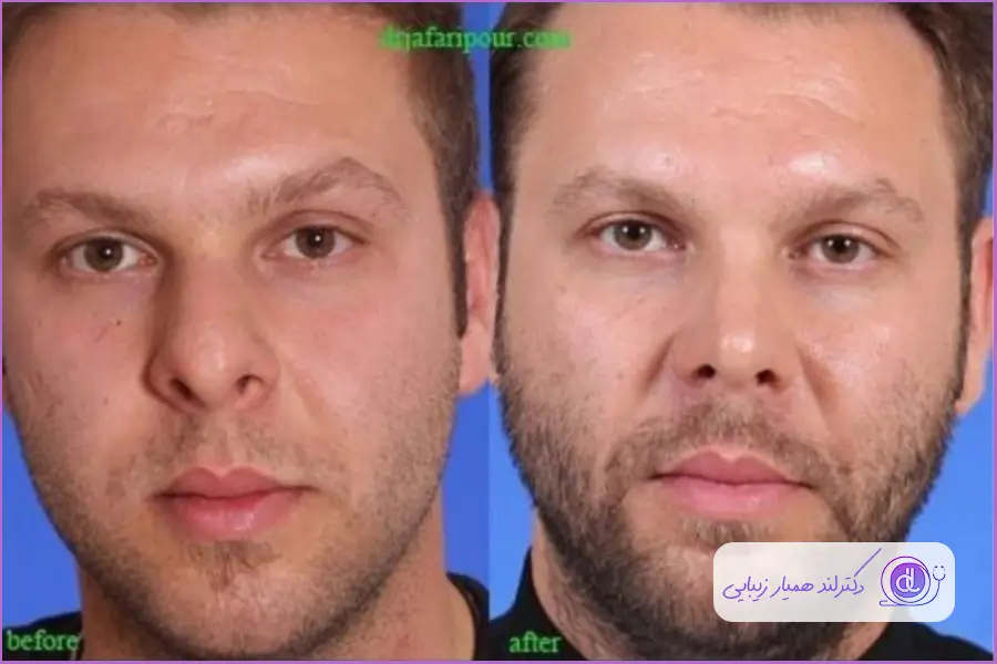 قبل و بعد جراحی زیبایی دماغ گوشتی مردانه دکتر مسعود جعفری پور