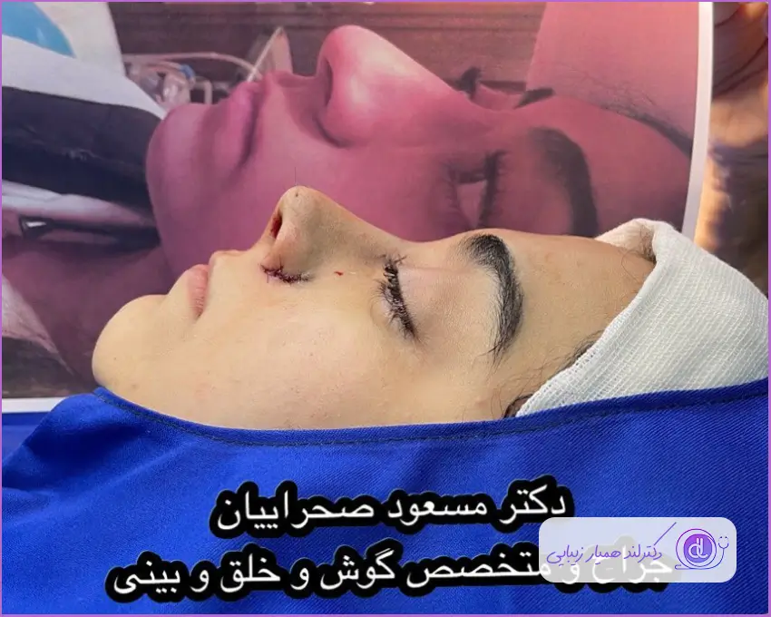 قبل و بعد جراحی زیبایی دماغ زنانه دکتر مسعود صحرائیان