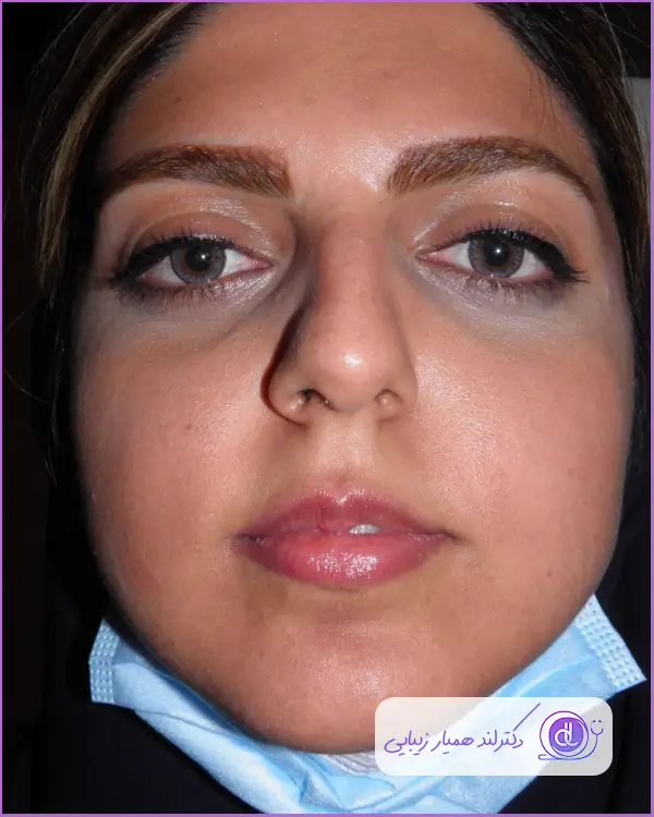 کوچک کردن بینی زنانه سبک طبیعی دکتر مسعود صحرائیان
