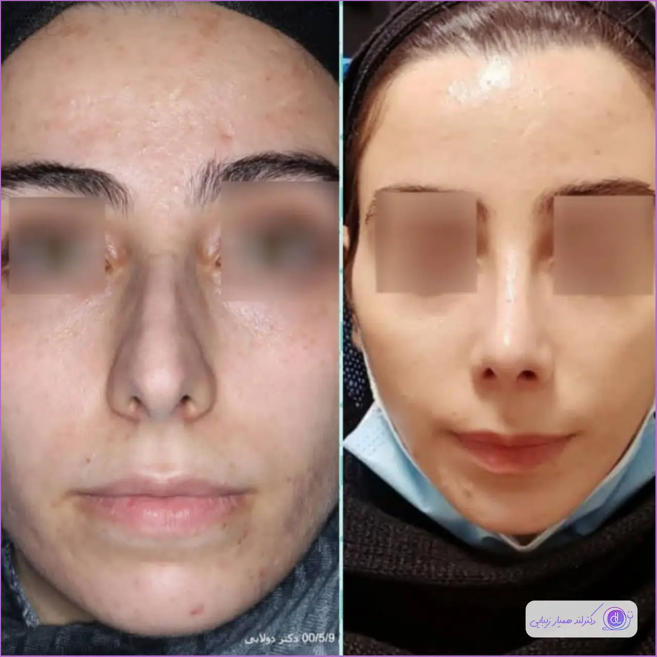 نمونه قبل و بعد جراحی بینی استخوانی زنانه در اراک