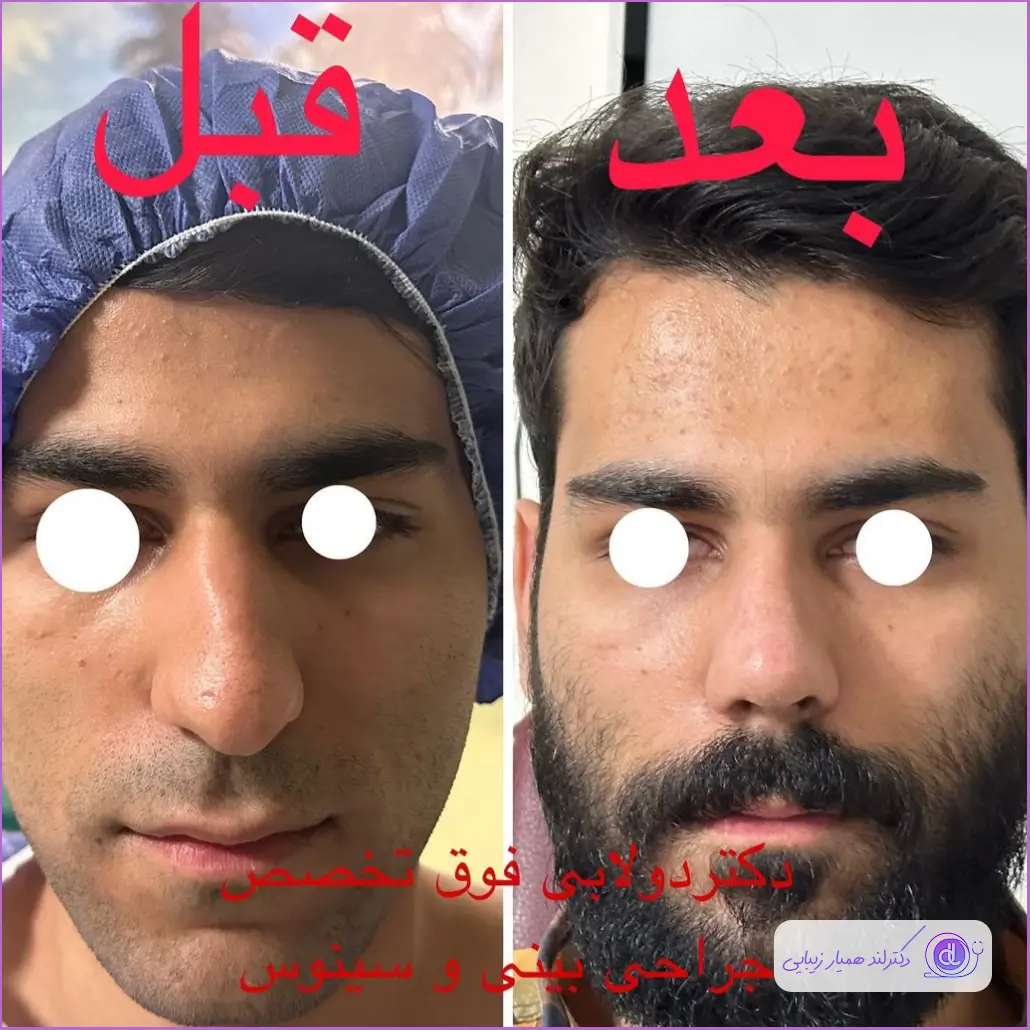 قبل و بعد رینوپلاستی گوشتی مردانه دکتر سید محمد دولابی