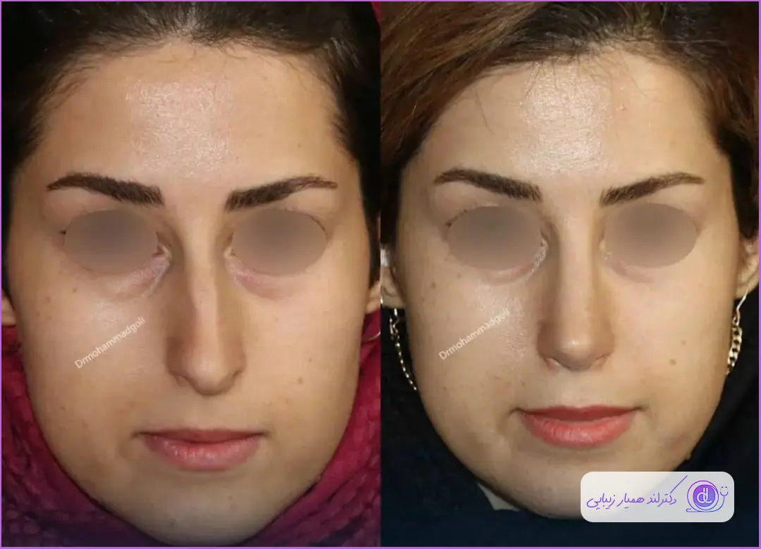 قبل و بعد عمل زیبایی بینی استخوانی به سبک طبیعی دکتر محمد گلی