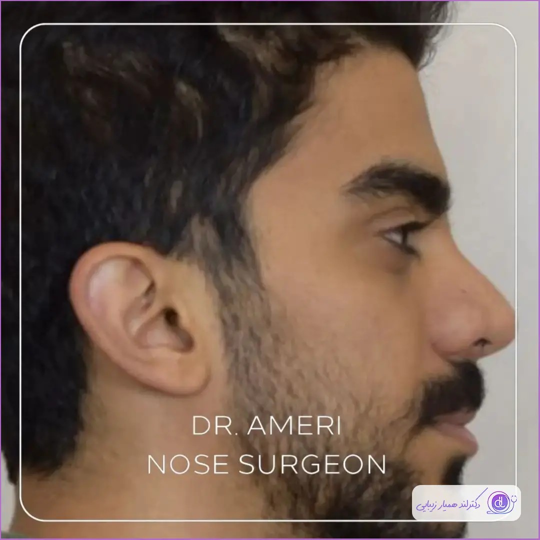 قبل و بعد جراحی زیبایی دماغ مردانه دکتر محمدحسن عامری