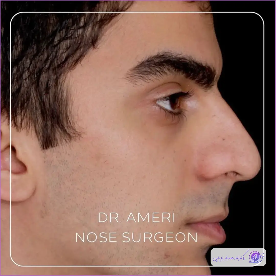 قبل و بعد جراحی زیبایی دماغ گوشتی مردانه دکتر محمدحسن عامری