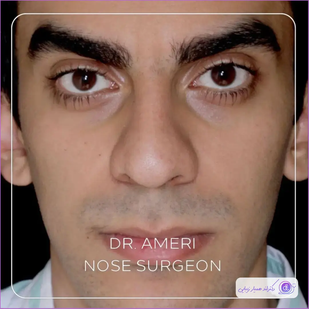 قبل و بعد عمل زیبایی بینی گوشتی مردانه دکتر محمدحسن عامری