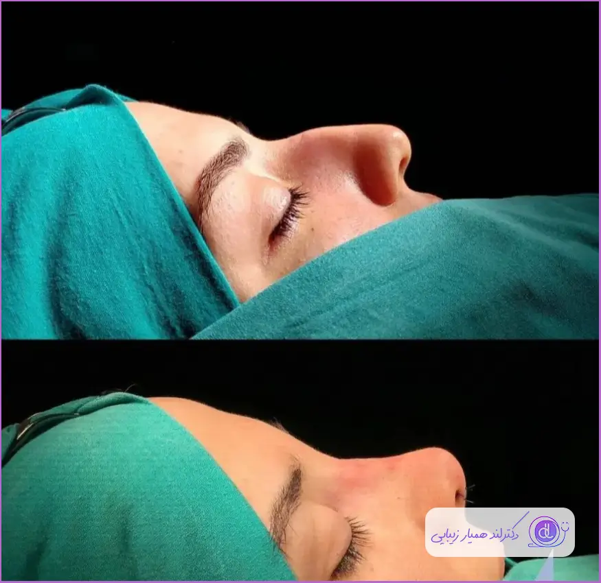 نمونه کوچک کردن بینی زنانه دکتر ناصر یاهو