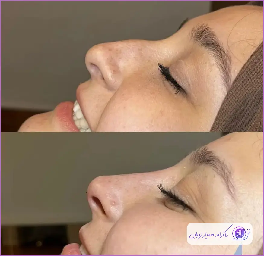 نمونه قبل و بعد عمل جراحی بینی زنانه دکتر ناصر یاهو