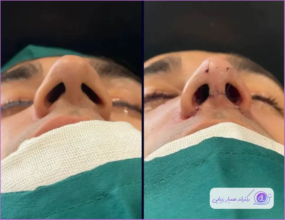 قبل و بعد جراحی بینی مردانه به روش بسته دکتر شاهین میلانی