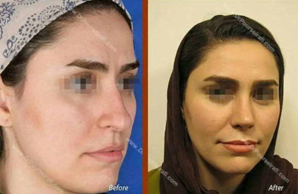 نمونه قبل و بعد جراحی زیبایی دماغ زنانه دکتر علیرضا پورصیرفی