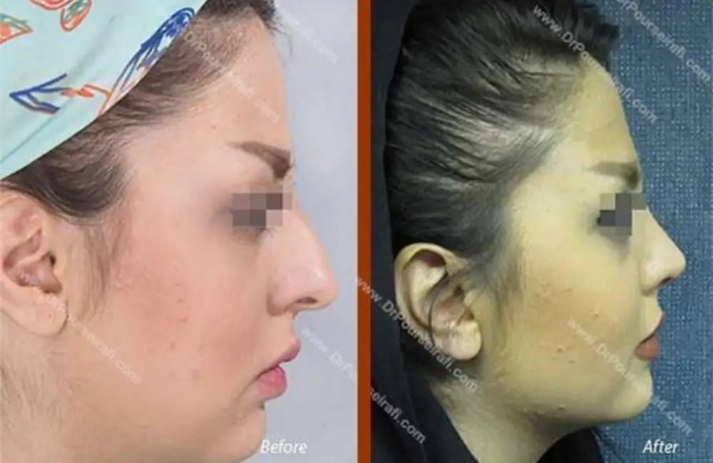 نمونه عمل جراحی بینی استخوانی زنانه دکتر علیرضا پورصیرفی