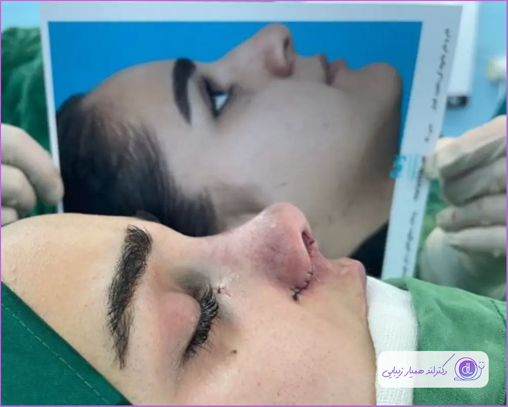 قبل و بعد عمل جراحی بینی زنانه به روش باز دکتر آرش طهماسبی