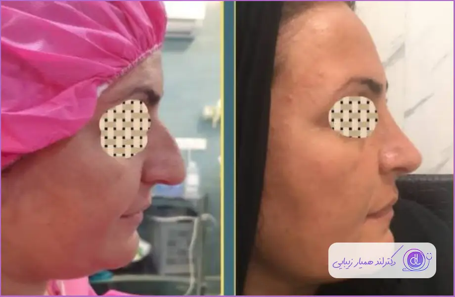 نمونه قبل و بعد عمل بینی گوشتی زنانه دکتر آزاده مرادی