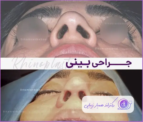 نمونه کار جراحی بینی طبیعی زنانه دکتر کامران بابایی