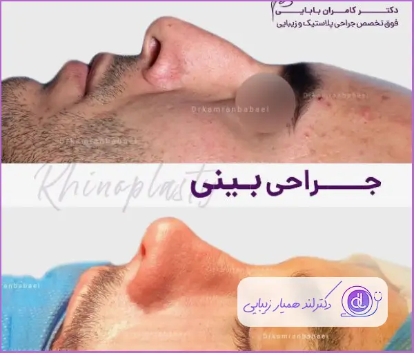 قبل و بعد جراحی بینی به سبک نیمه فانتزی مردانه دکتر کامران بابایی