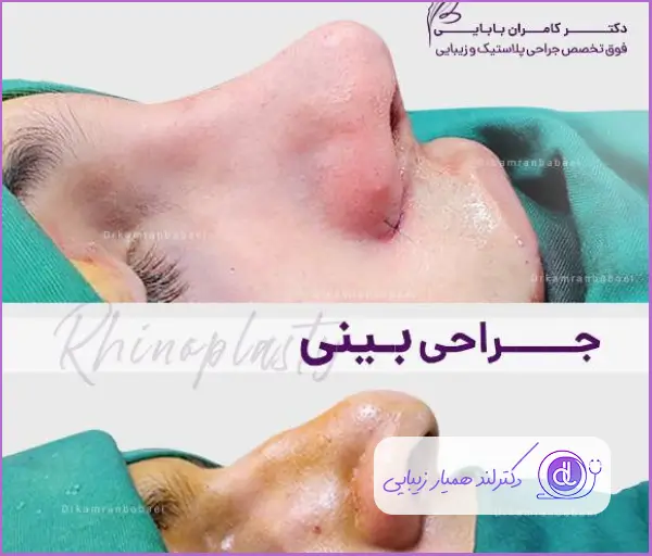 قبل و بعد جراحی زیبایی بینی گوشتی نیمه فانتزی زنانه دکتر کامران بابایی