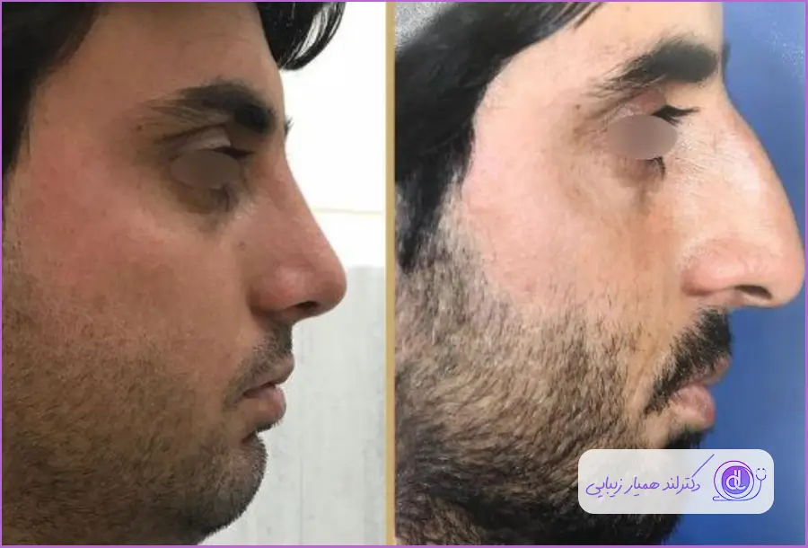 قبل و بعد جراحی زیبایی بینی مردانه دکتر لیلا اسدپور