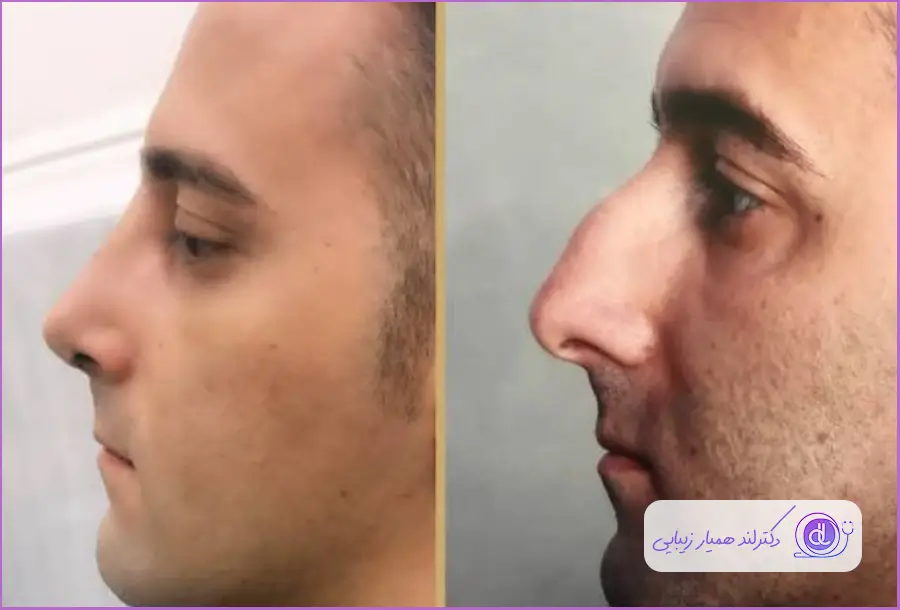 نمونه قبل و بعد عمل بینی استخوانی در کرج