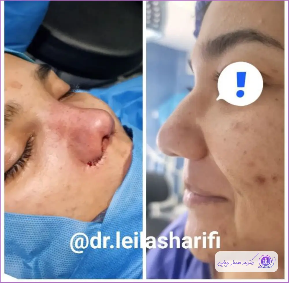 قبل و بعد عمل بینی گوشتی به روش باز دکتر لیلا شریفی