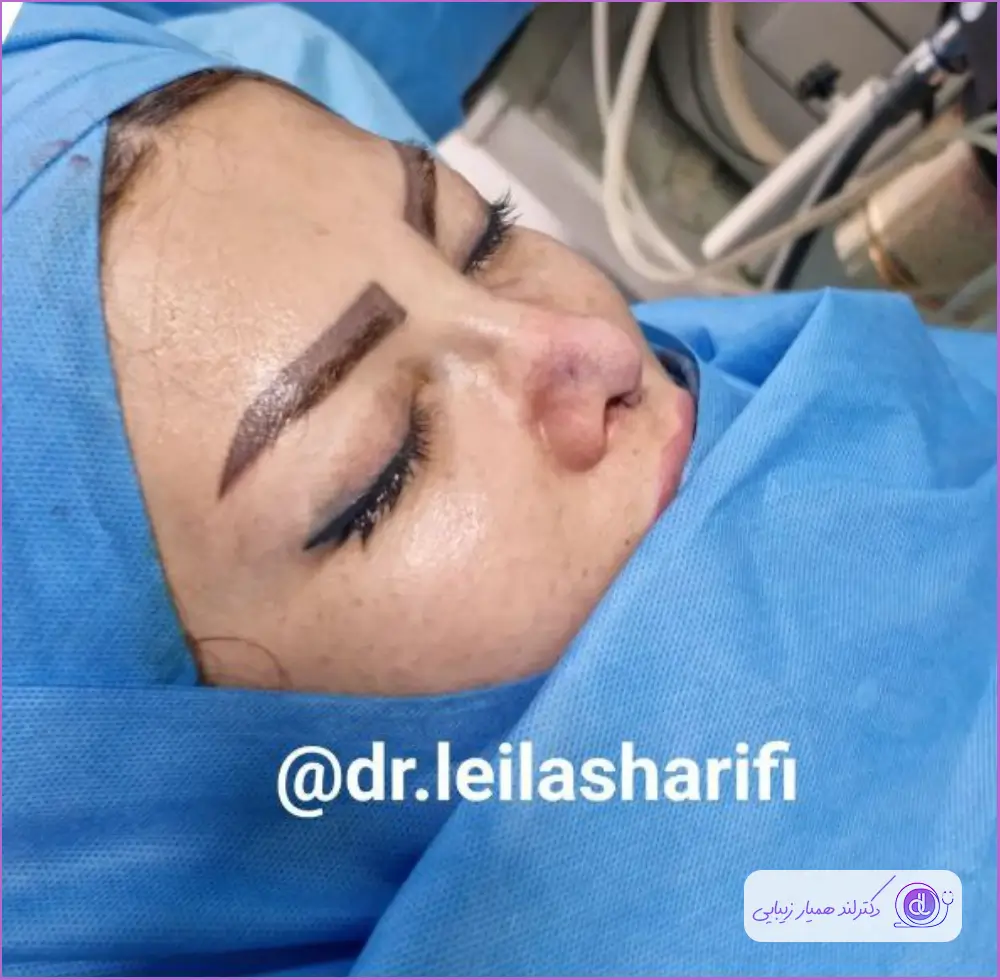 نمونه جراحی زیبایی دماغ زنانه دکتر لیلا شریفی