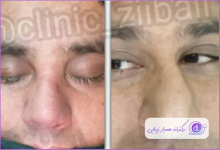 قبل و بعد جراحی بینی گوشتی طبیع مردانه دکتر لیلا مشعلی