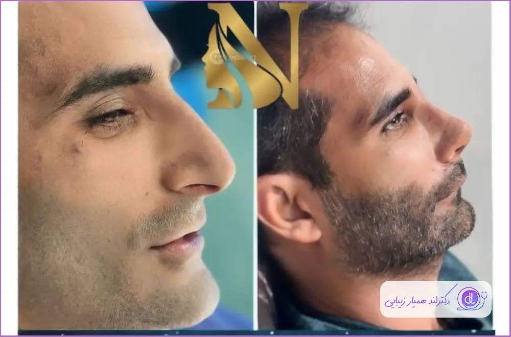 قبل و بعد عمل زیبایی بینی استخوانی مردانه دکتر لطفعلی نوروزی